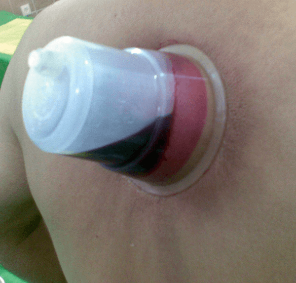  The benefits of cupping